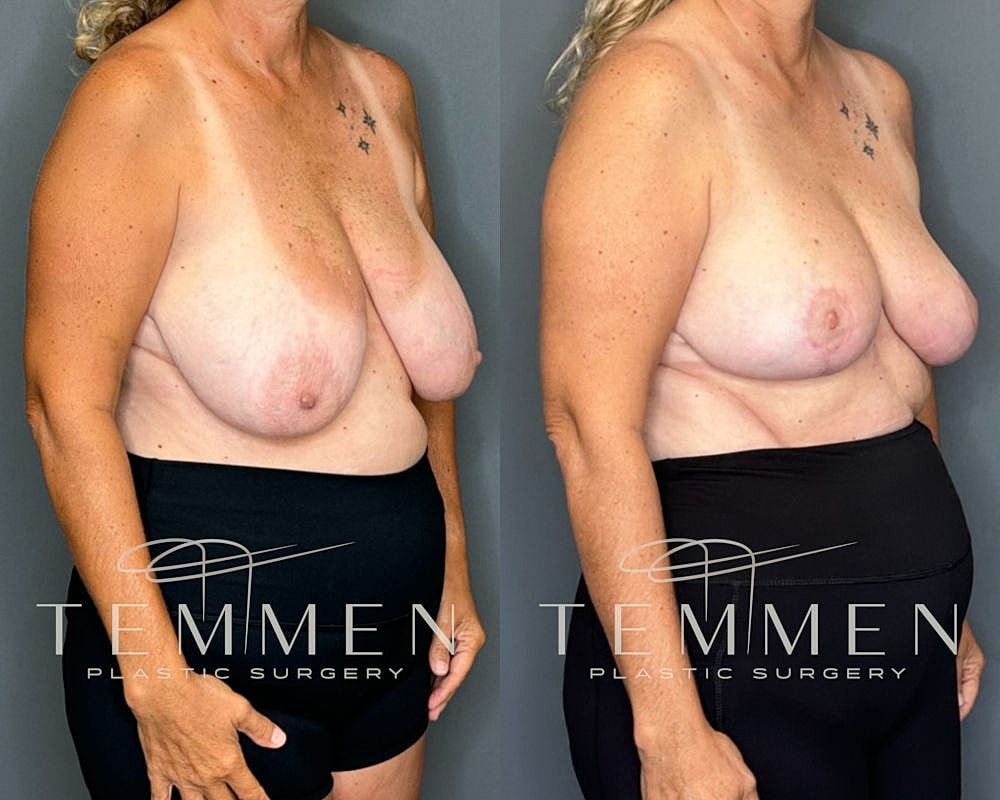 Before and after breast surgery comparison photo.