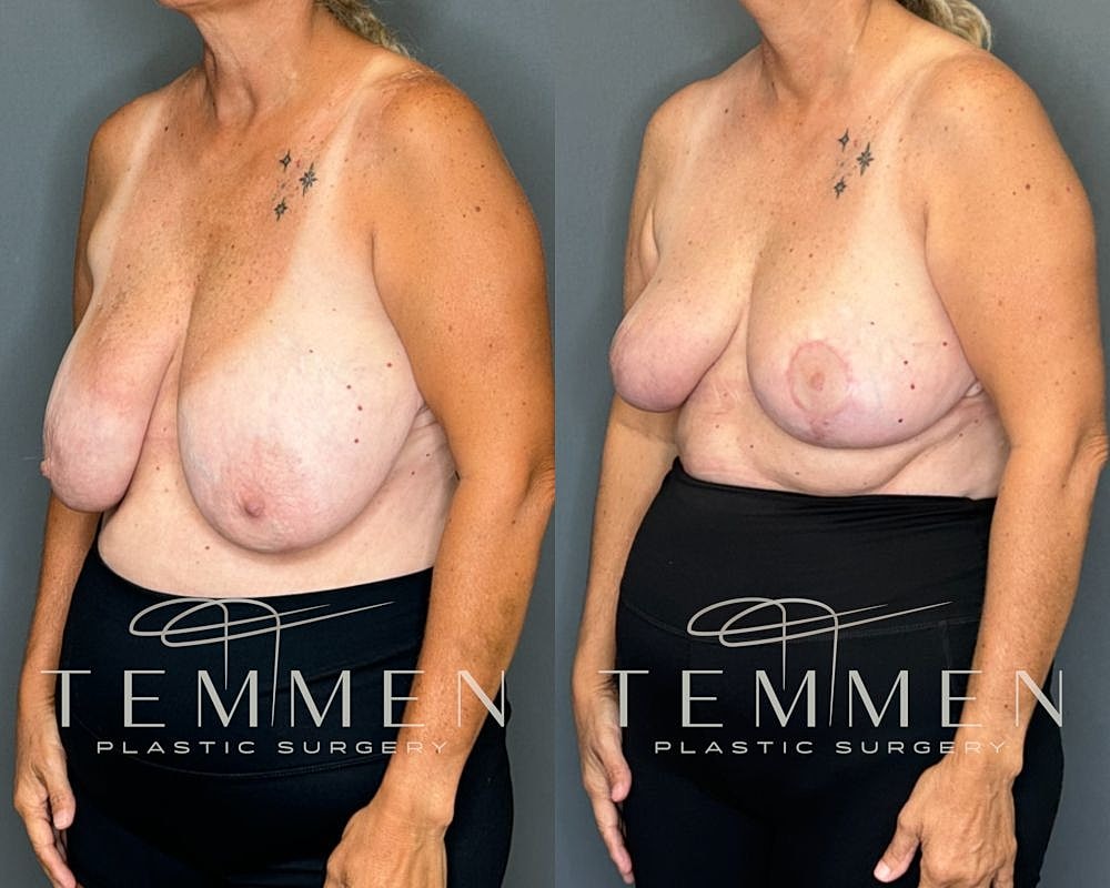 Before and after breast surgery comparison image.