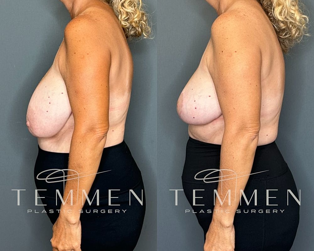 Side-by-side before and after breast surgery.