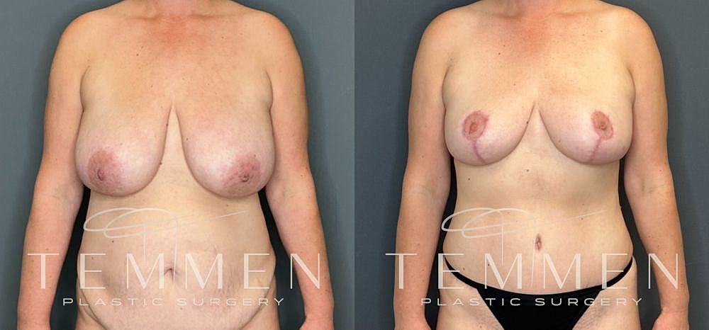 Before and after breast enhancement surgery results.