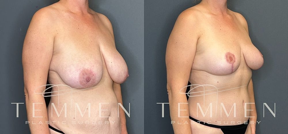 Before and after breast surgery comparison image