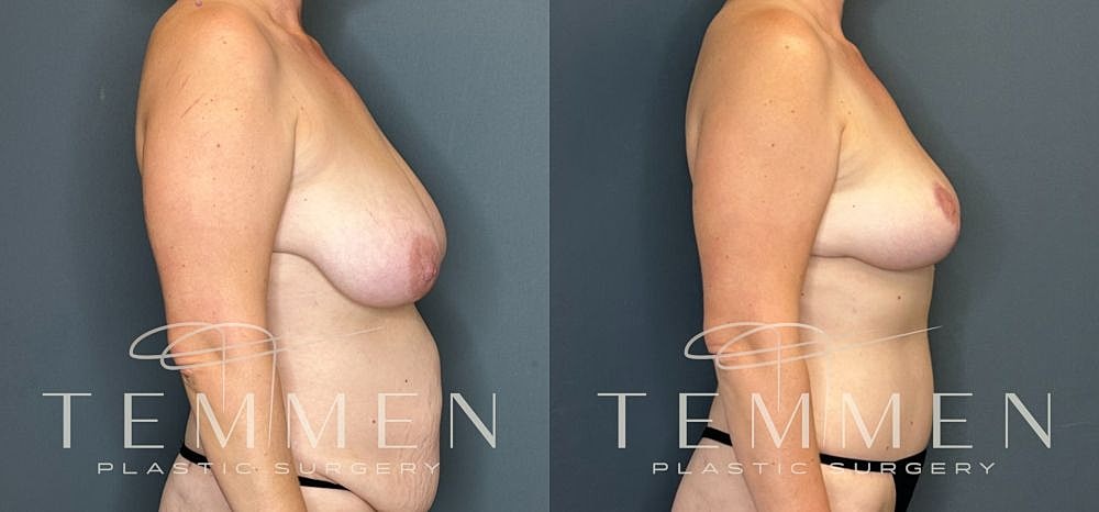 Before and after breast surgery comparison images.