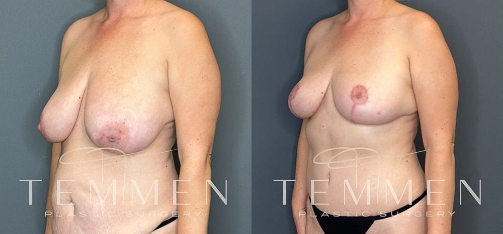 Before and after breast augmentation photos.