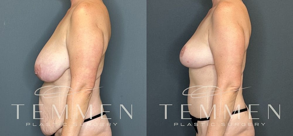 Before and after breast enhancement transformation.