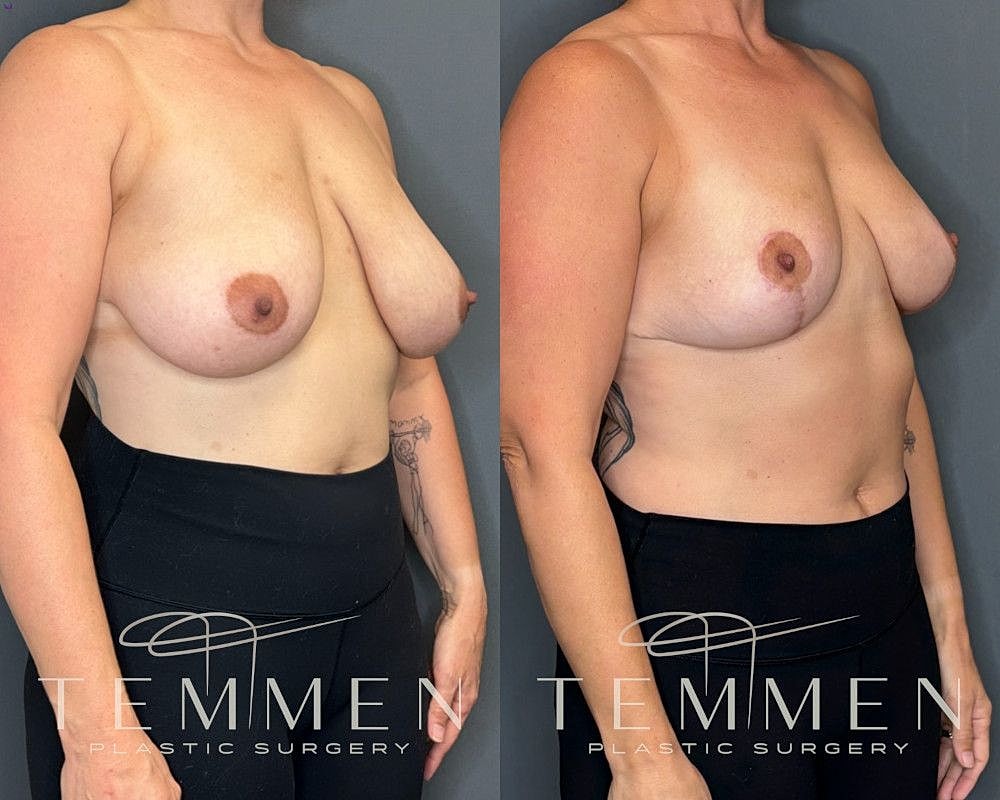 Breast Reduction Before & After