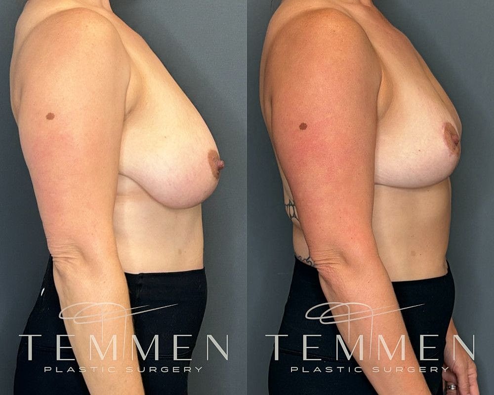 Breast Reduction Before & After