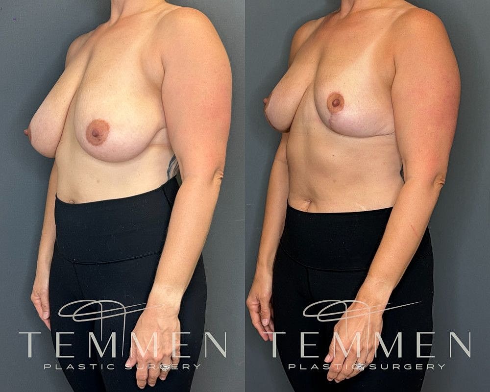 Breast Reduction Before & After