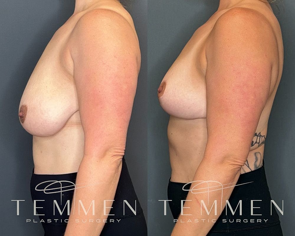 Breast Reduction Before & After