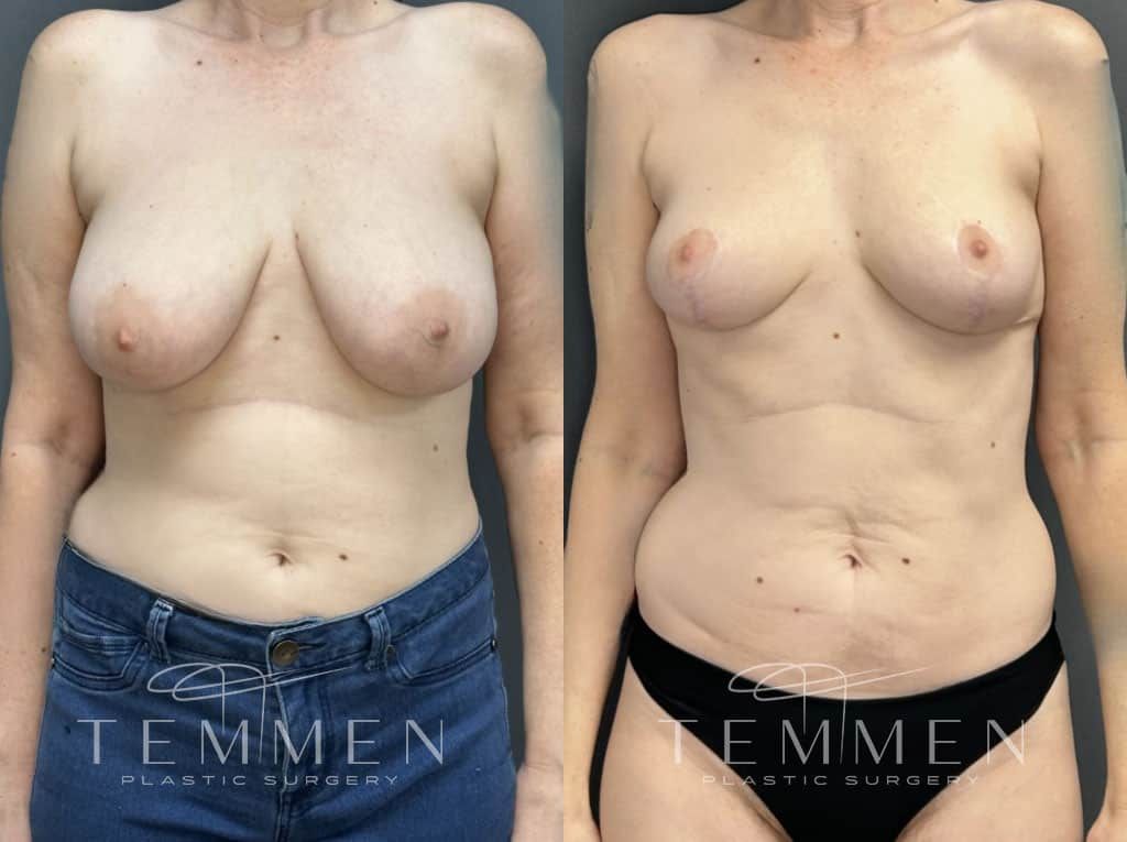 Breast Reduction Before & After