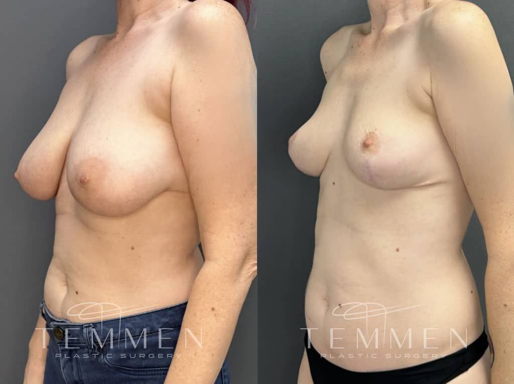 Breast Reduction Before & After