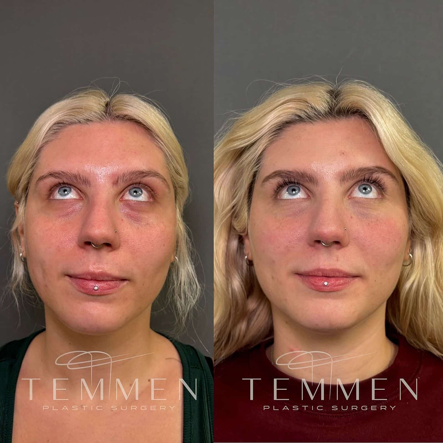 Before and after plastic surgery transformation.