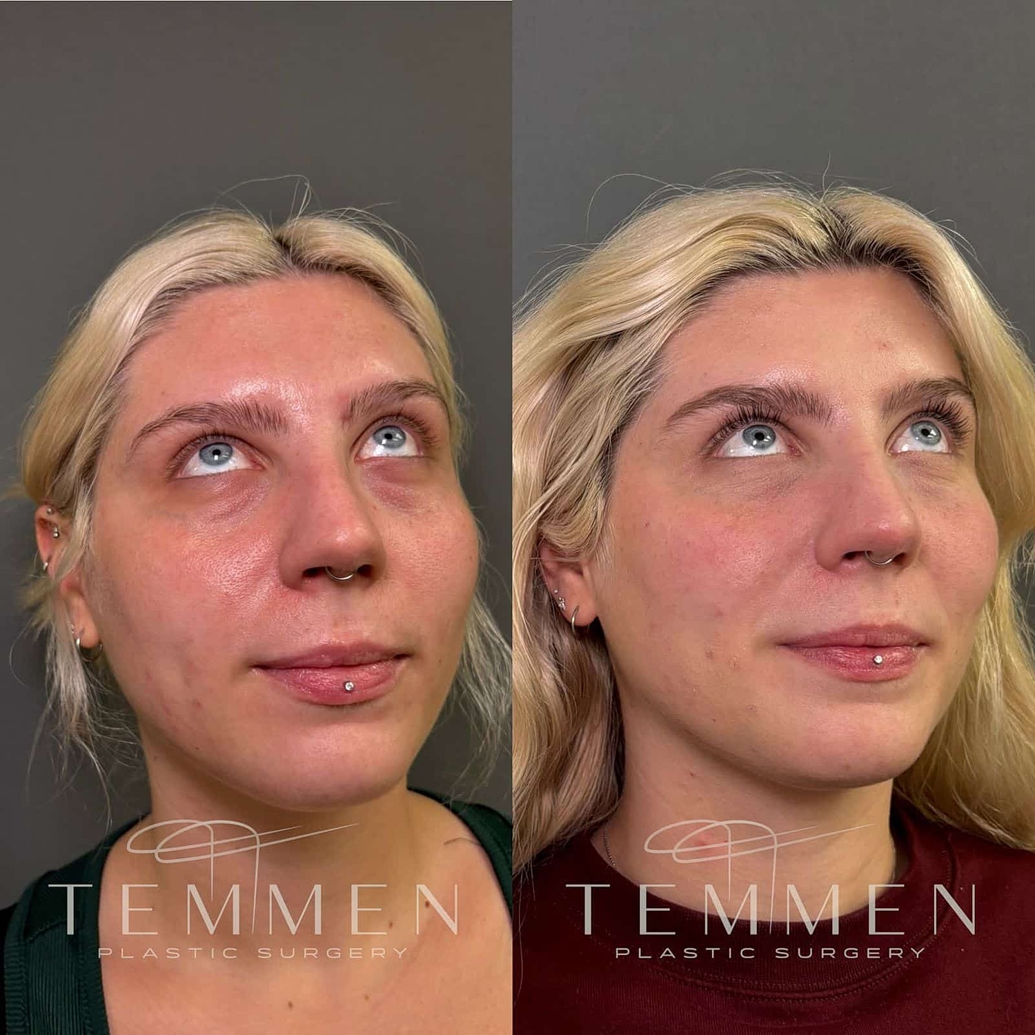 Before and after plastic surgery transformation comparison.