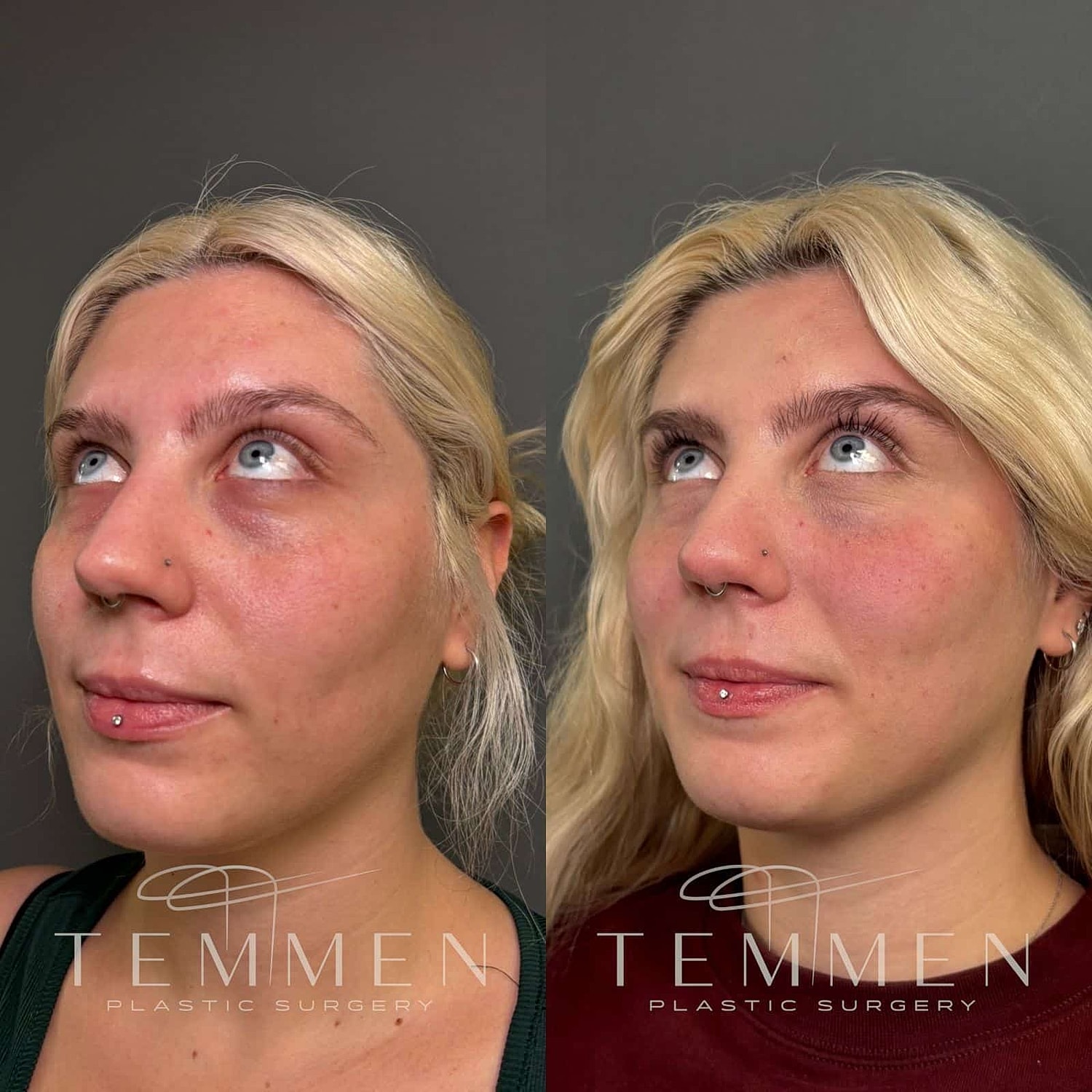 Before and after plastic surgery results comparison.