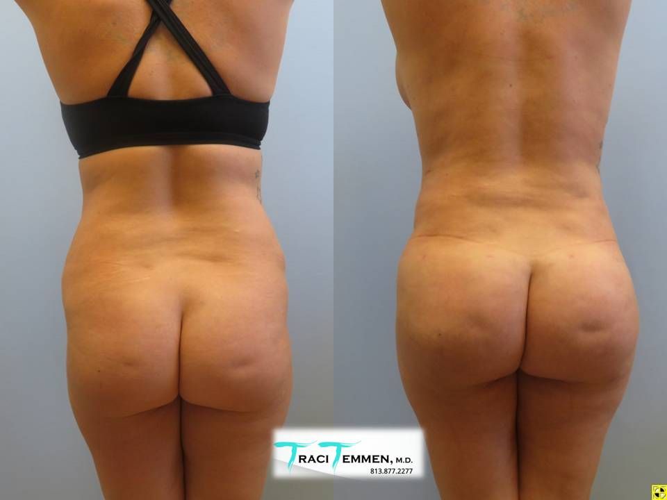 Brazilian Butt Lift Revision Before & After