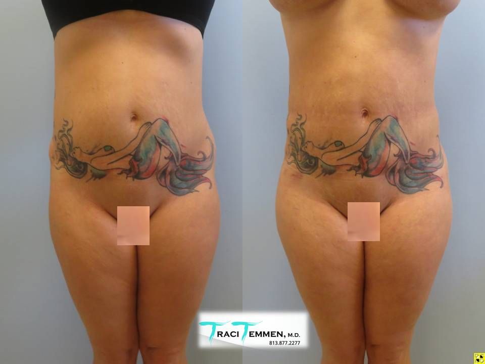 Brazilian Butt Lift Revision Before & After