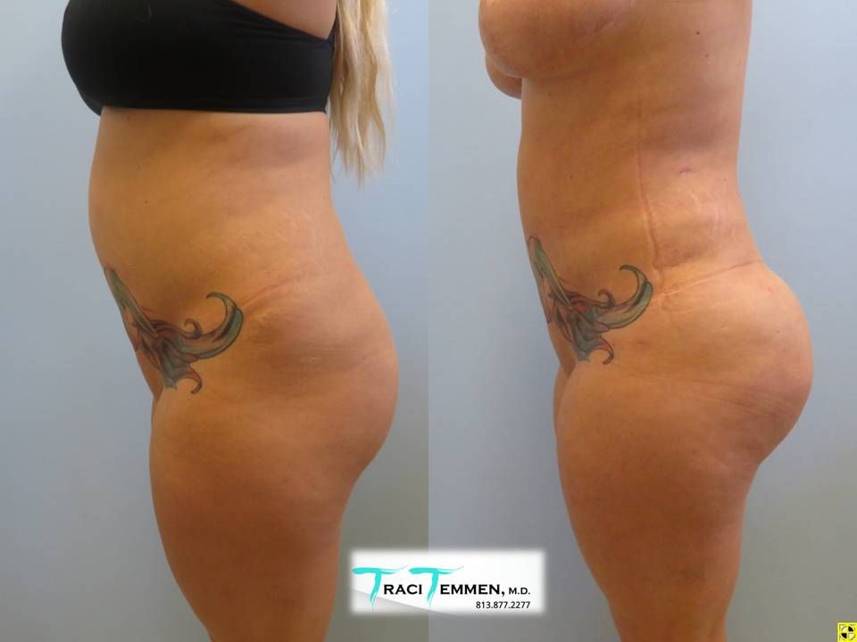 Brazilian Butt Lift Revision Before & After