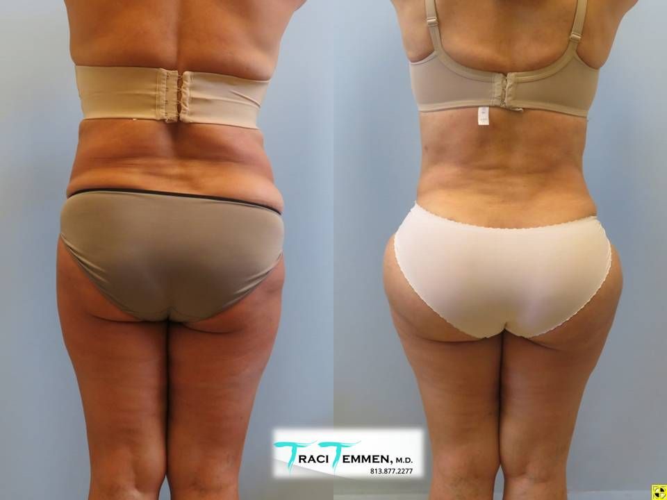 Brazilian Butt Lift Revision Before & After