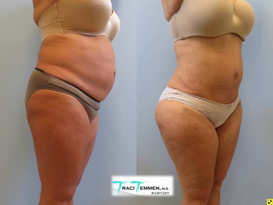 Brazilian Butt Lift Revision Before & After