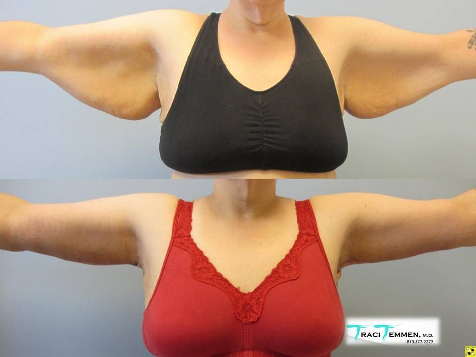 Arm Lift Before & After