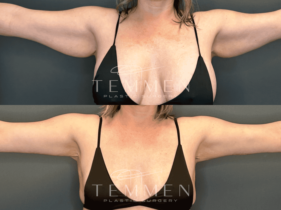 Arm Lift Before & After