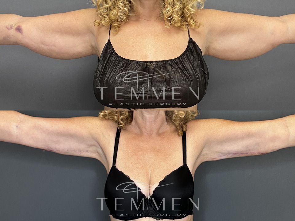 Arm Lift Before & After