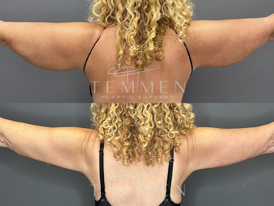 Arm Lift Before & After