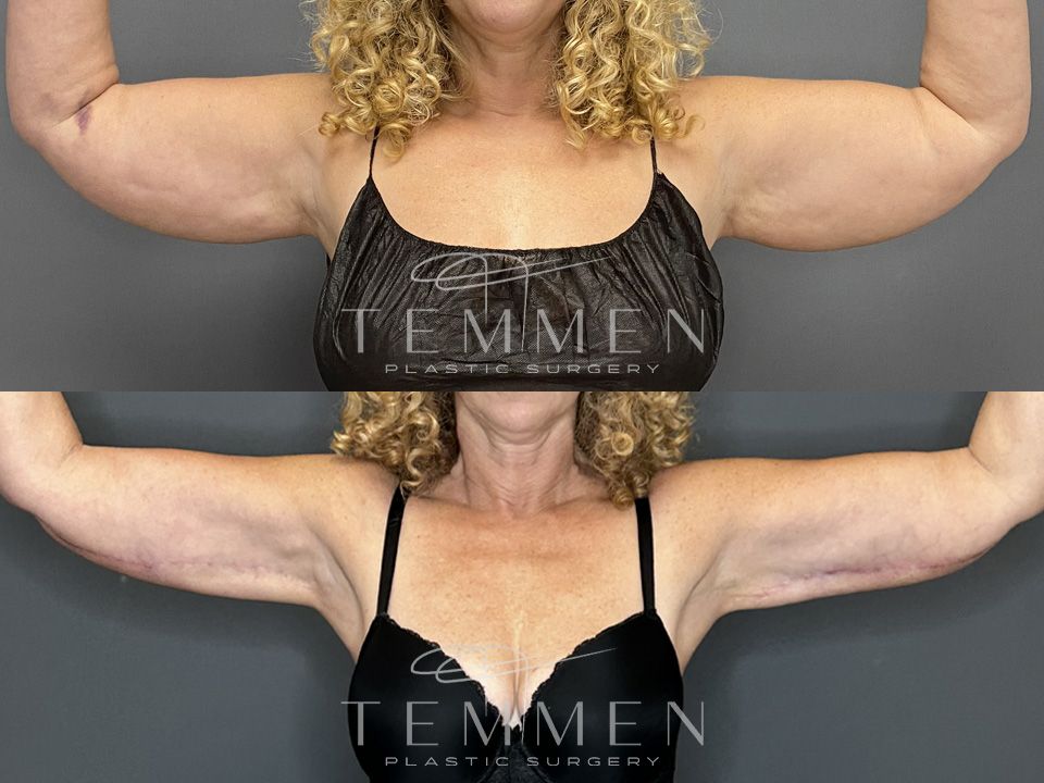 Arm Lift Before & After