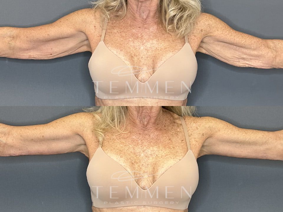 Arm Lift Before & After