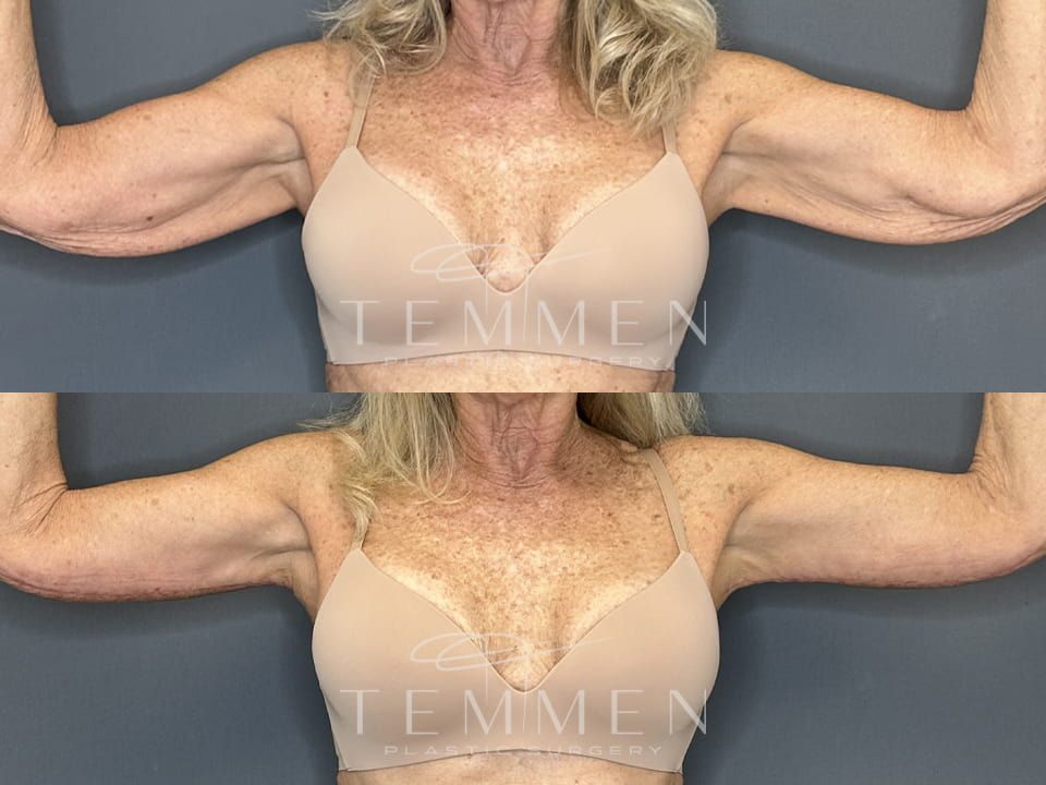 Arm Lift Before & After