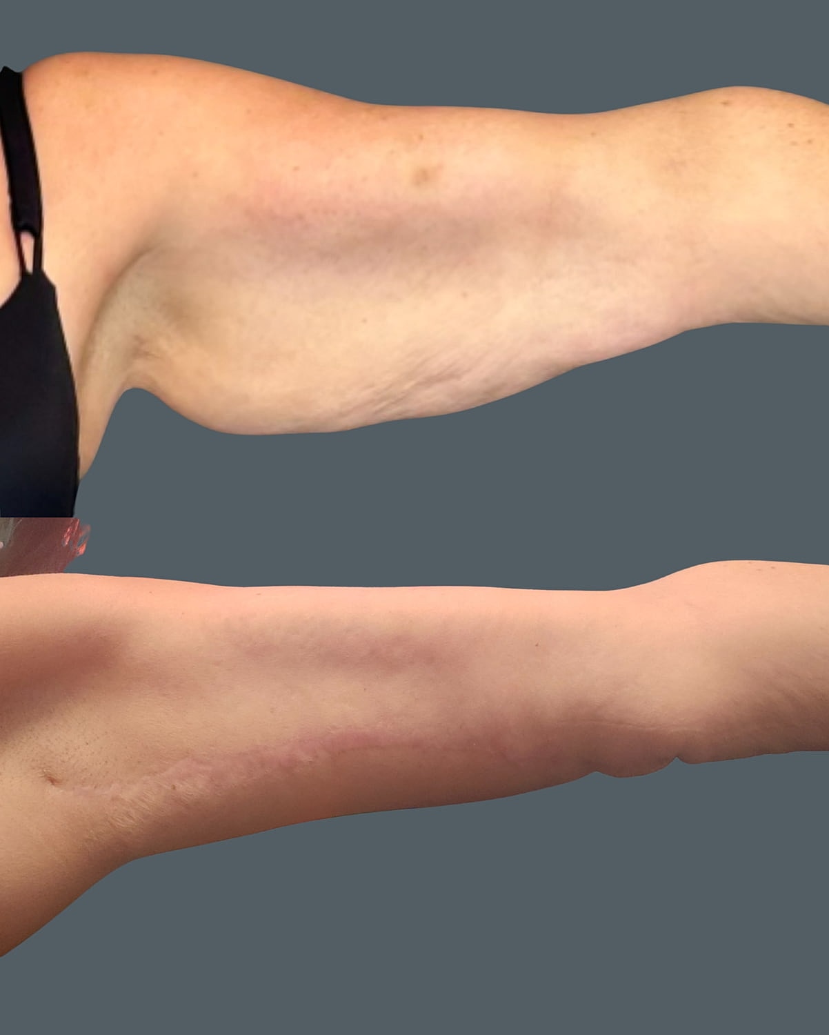 Arm Lift Before & After