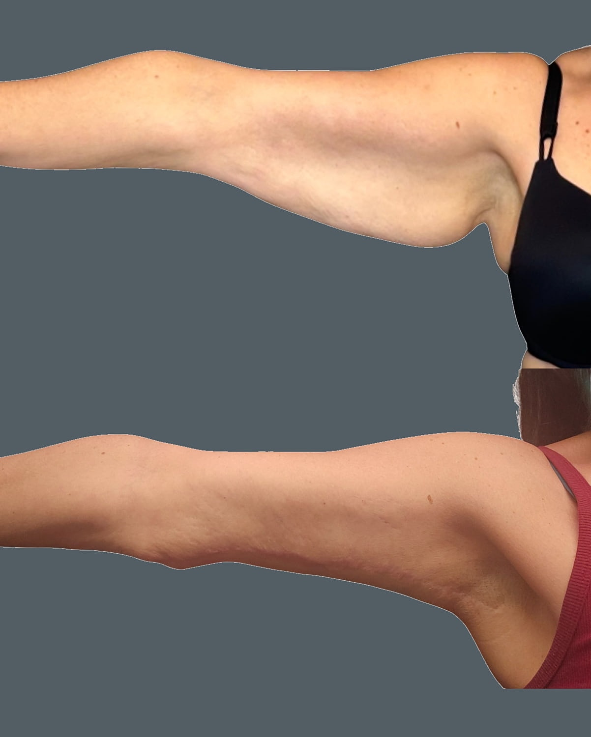 Arm Lift Before & After