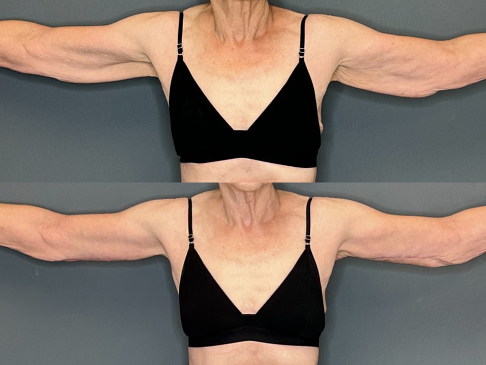 Arm Lift Before & After