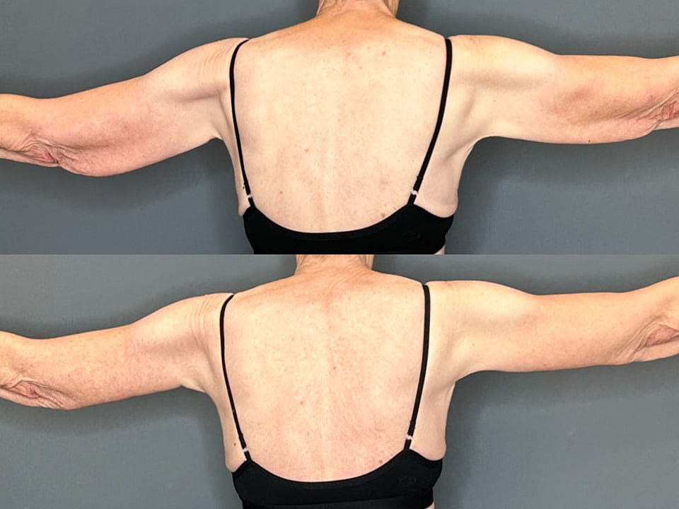 Arm Lift Before & After