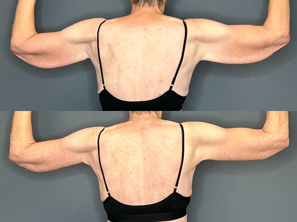 Arm Lift Before & After