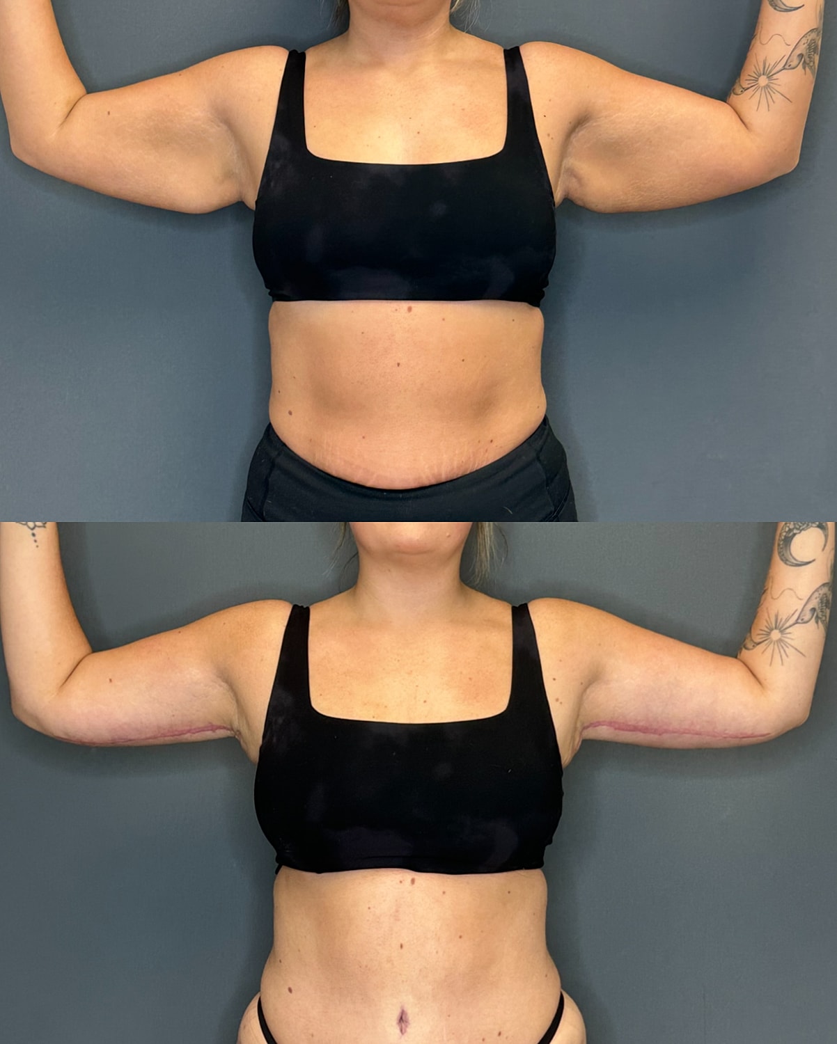 Arm Lift Before & After