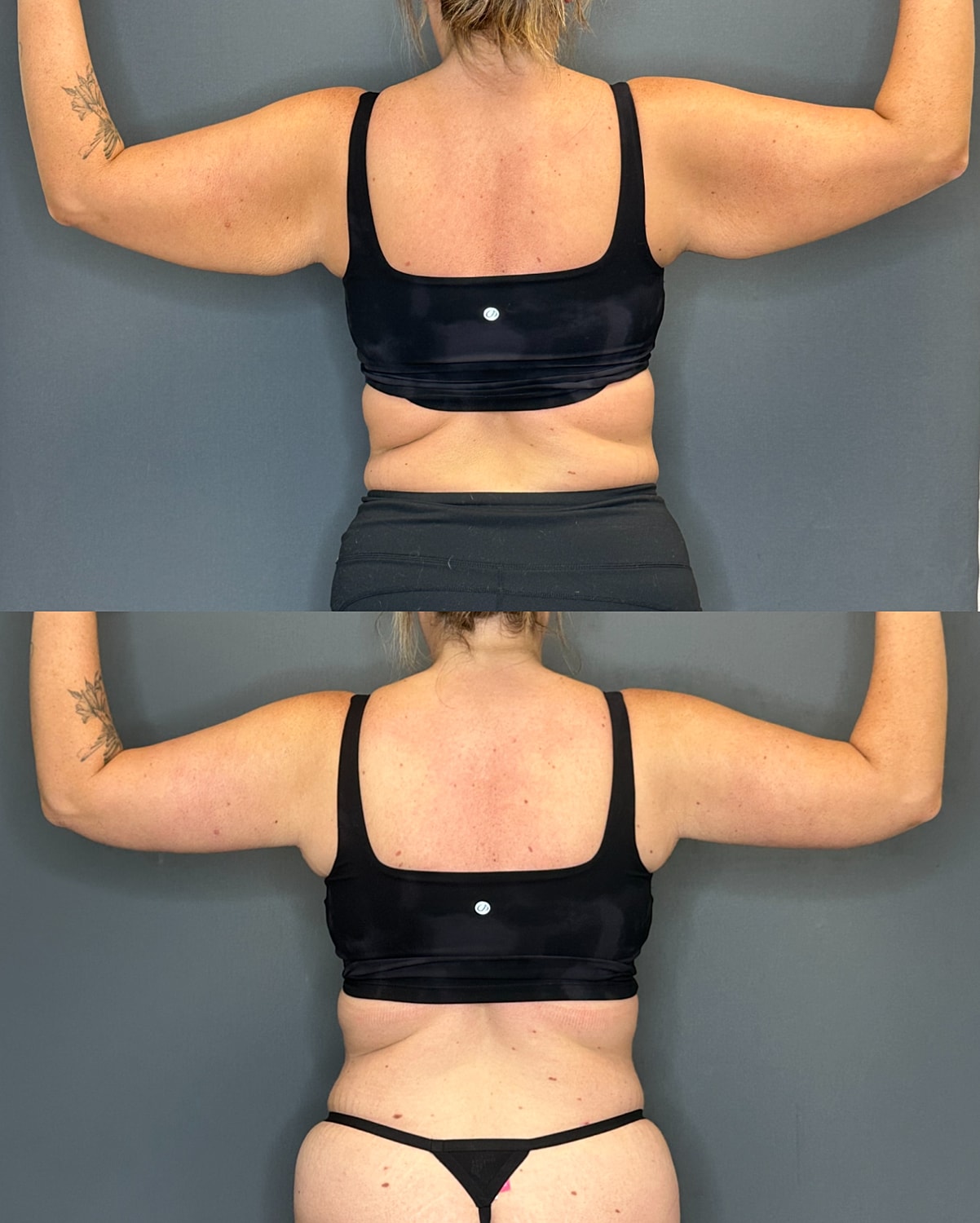Arm Lift Before & After