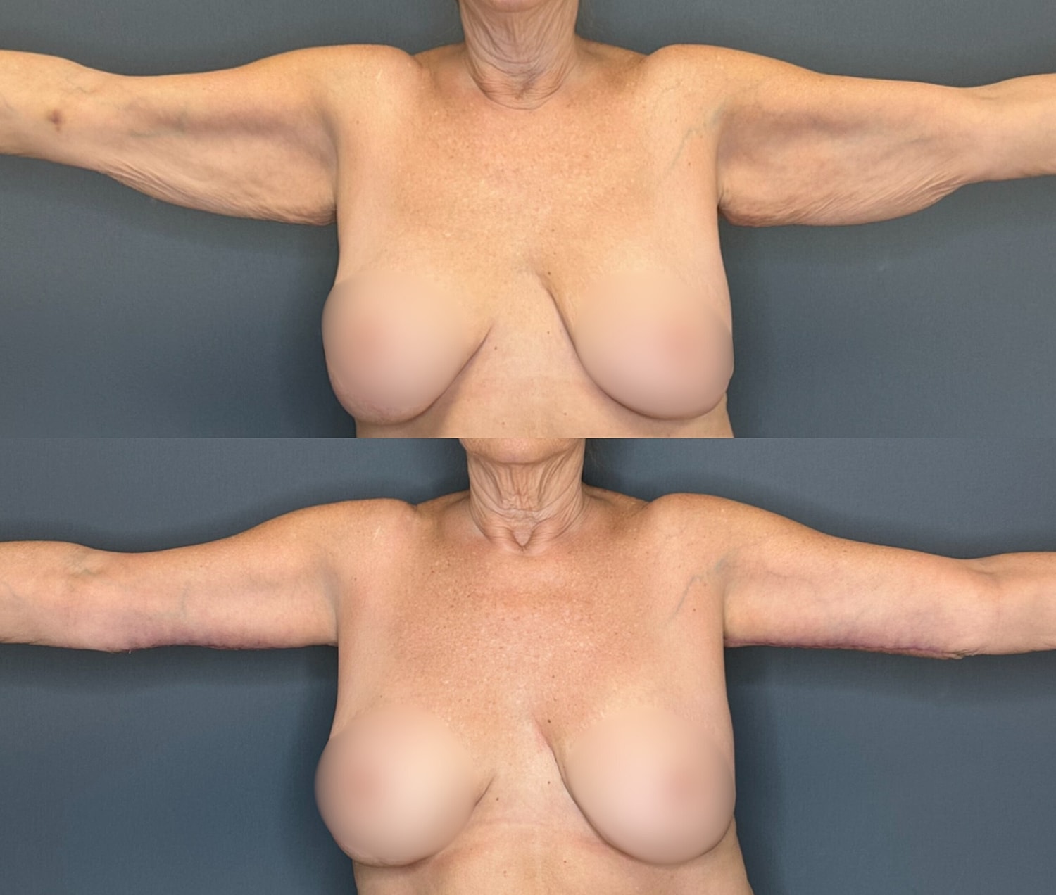 Arm Lift Before & After