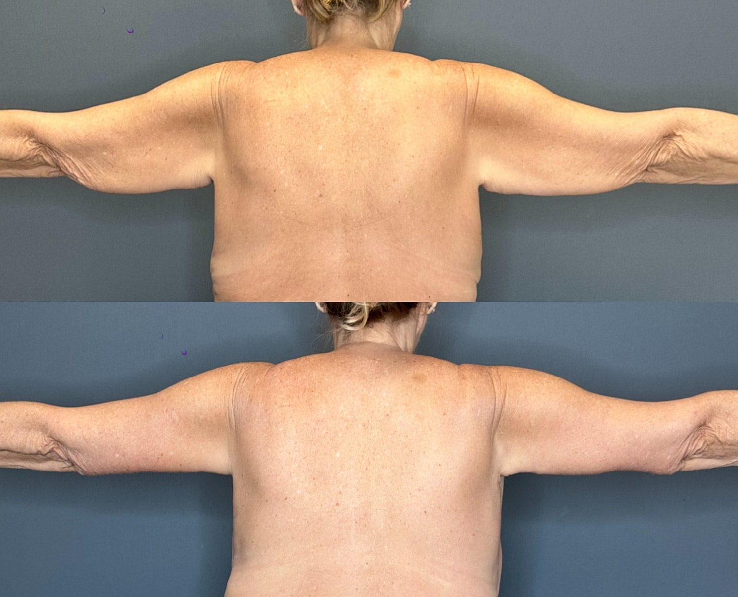 Arm Lift Before & After