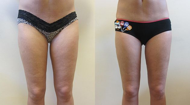 Mini Thigh Lift Before & After