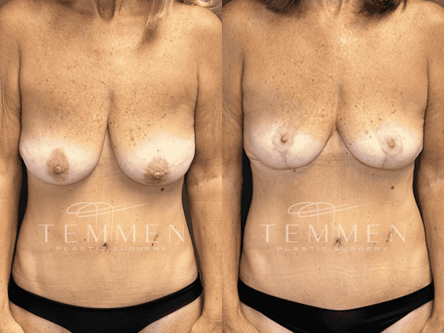 Breast Lift Before & After