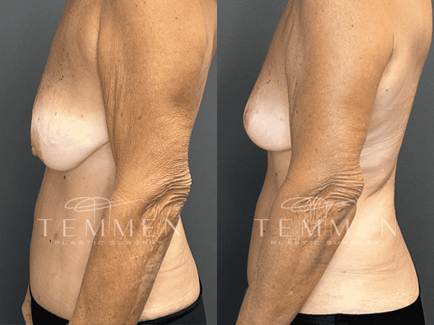 Breast Lift Before & After