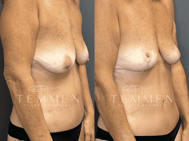 Breast Lift Before & After
