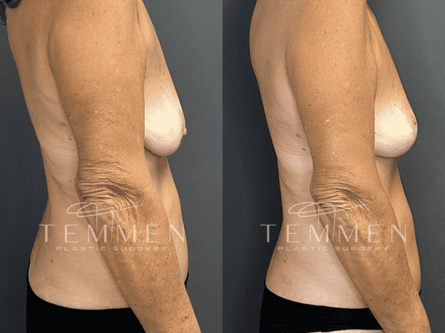 Breast Lift Before & After