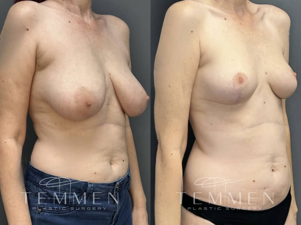 Breast Lift Before & After