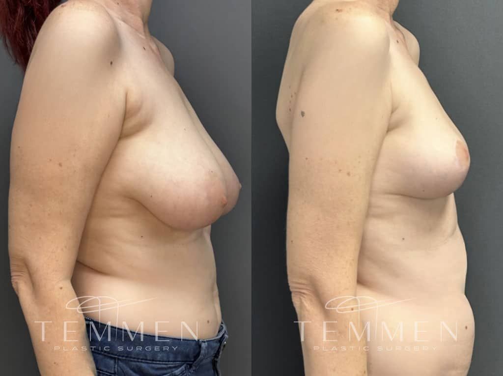 Breast Lift Before & After