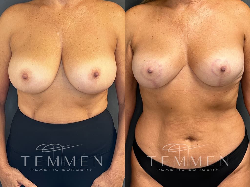 Breast Lift Before & After