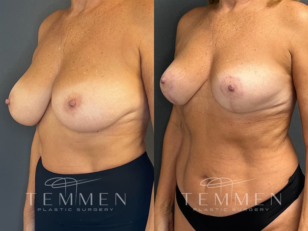 Breast Lift Before & After