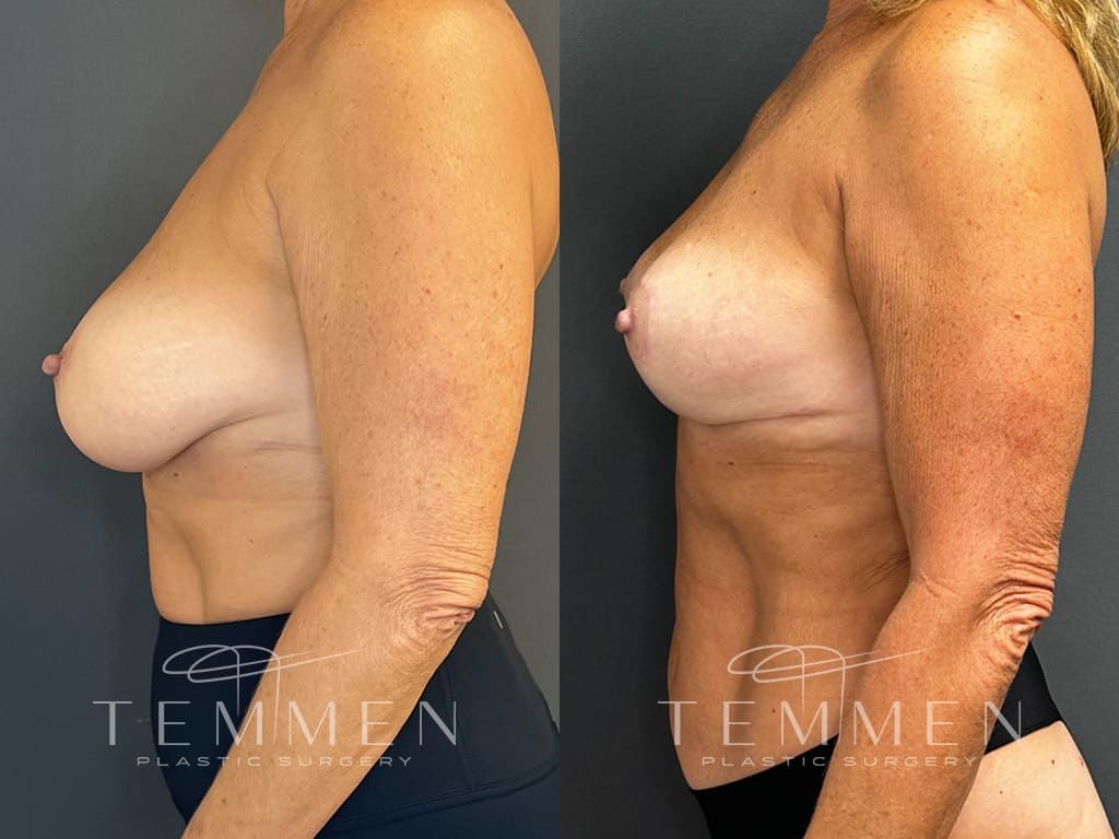 Breast Lift Before & After