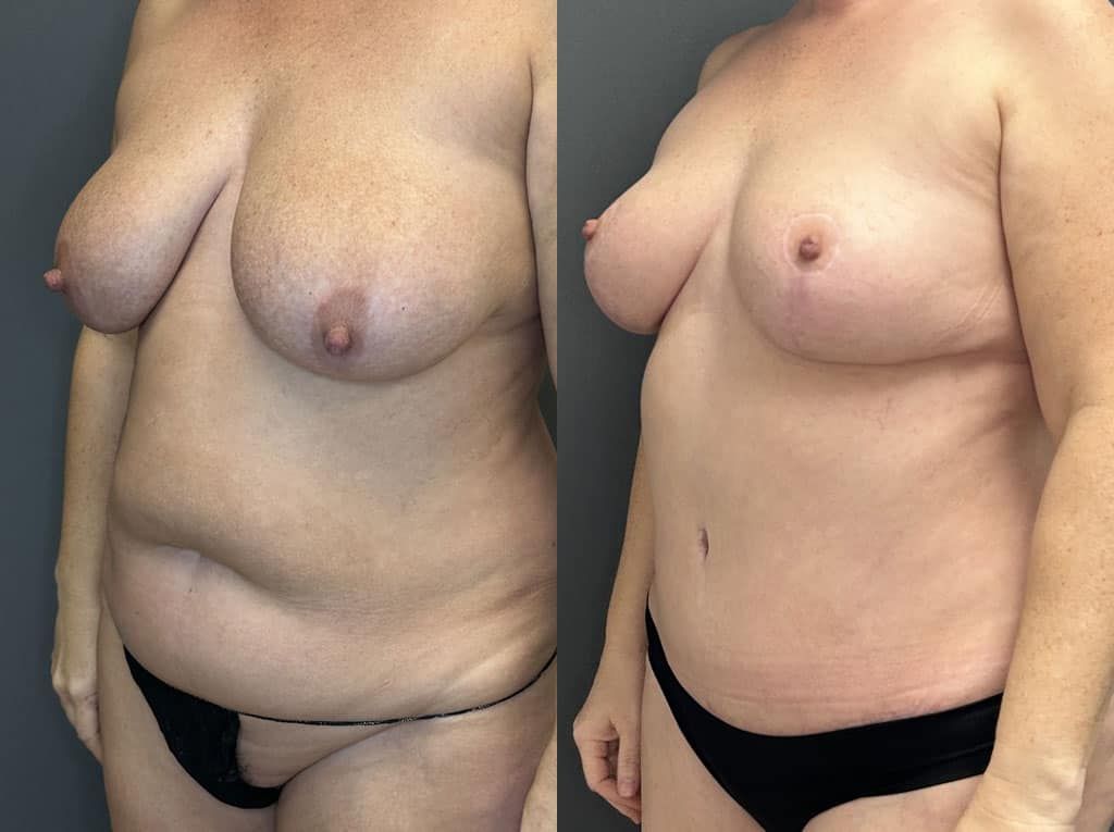 Breast Lift Before & After