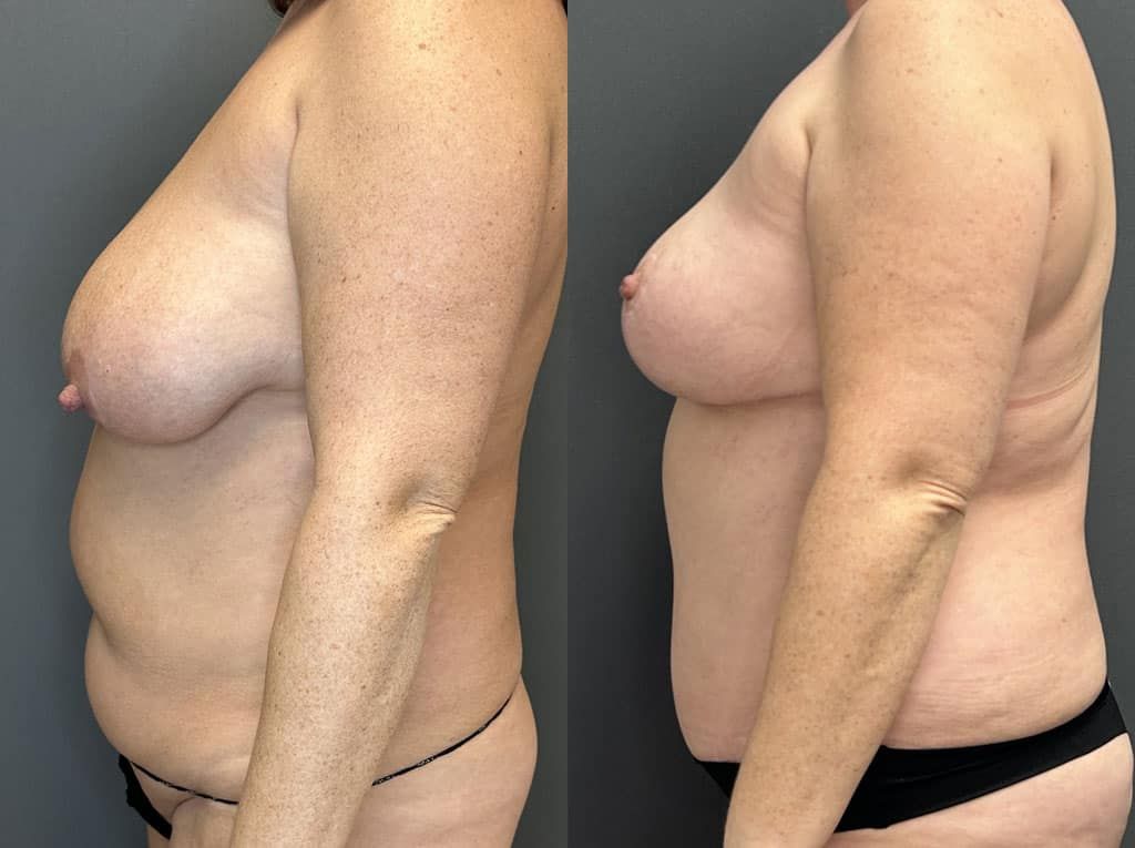 Breast Lift Before & After